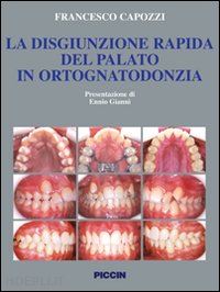 capozzi francesco - la disgiunzione rapida del palato in ortognatodonzia