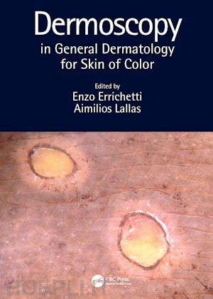 errichetti enzo (curatore); lallas aimilios (curatore) - dermoscopy in general dermatology for skin of color