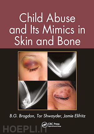 brogdon b. g.; shwayder tor; elifritz jamie - child abuse and its mimics in skin and bone