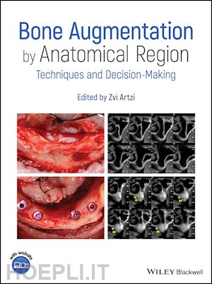 artzi z - bone augmentation by anatomical region – techniques and decision–making