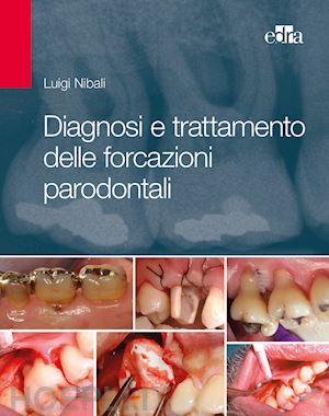 nibali luigi - diagnosi e trattamento delle forcazioni parodontali