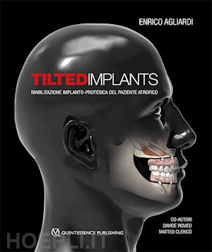 agliardi enrico; romeo davide, clerico' matteo - tilted implants - riabilitazione implanto-protesica del paziente atrofico