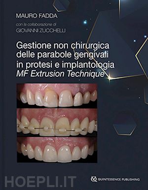 fadda mauro; zuccchelli giovanni (coll.) - mf extrusion technique. gestione non chirurgica delle parabole gengivali