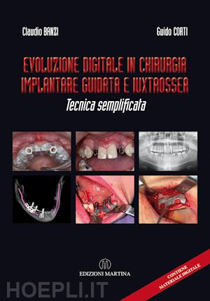 banzi claudio; corti guido - evoluzione digitale in chirurgia implantare guidata e iuxtaossea. tecnica sempli