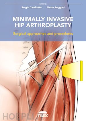 candiotto sergio; ruggieri pietro - minimally invasive hip arthroplasty. surgical approaches and procedures