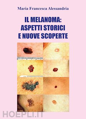 alessandria maria francesca - il melanoma: aspetti storici e nuove scoperte